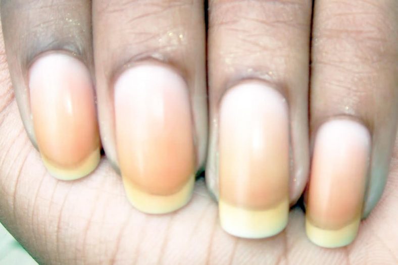 What Causes Nail Discoloration & How to Treat It  We Heart Nails