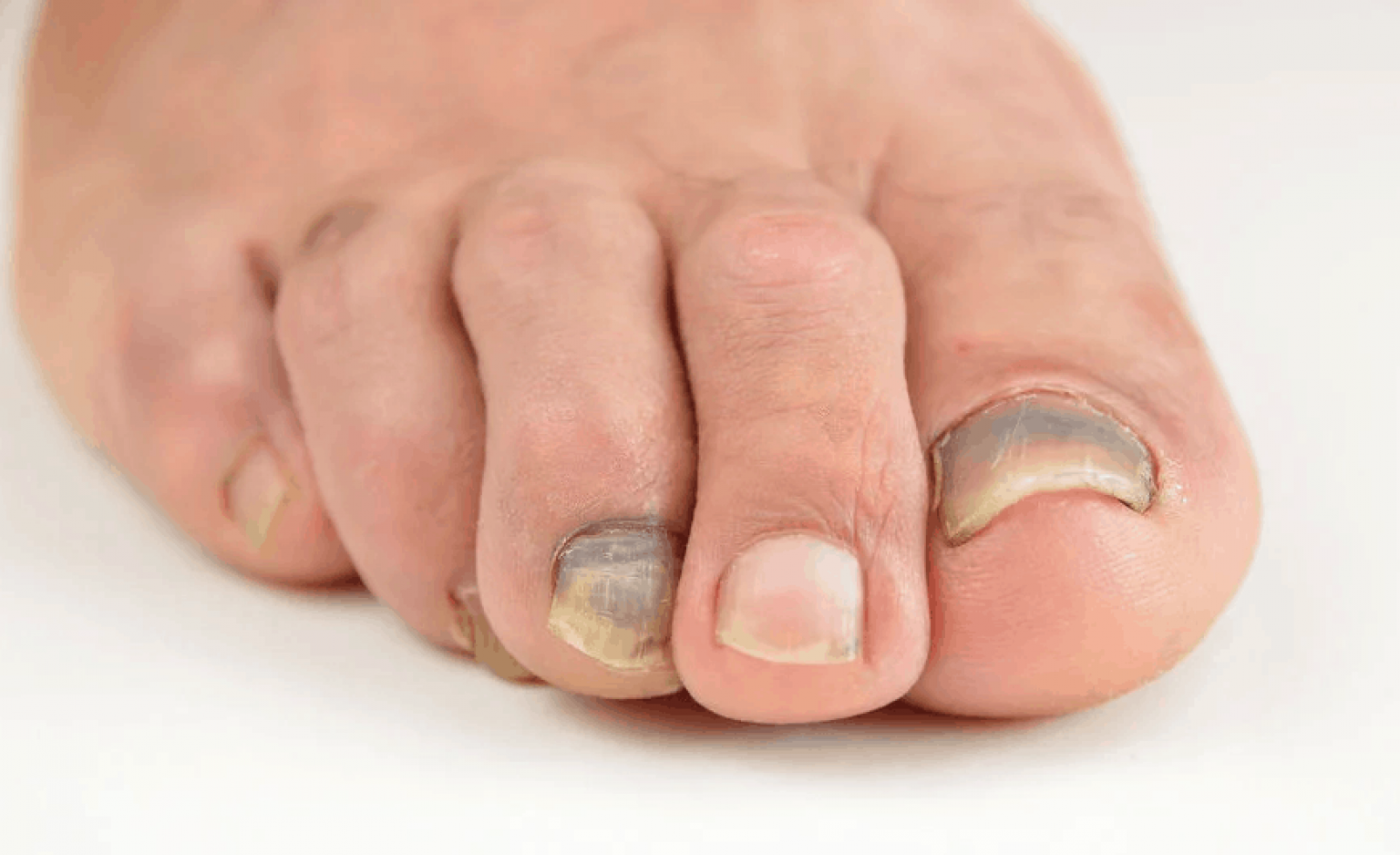 suffering-with-dark-spots-under-your-toenails-treatments