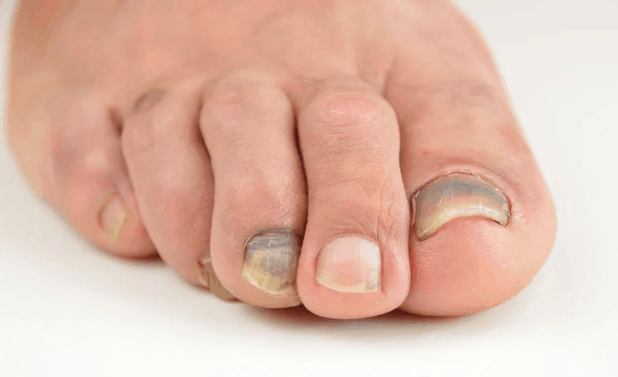 Brown spot on toenail...: I know this isn't really... - LUPUS UK