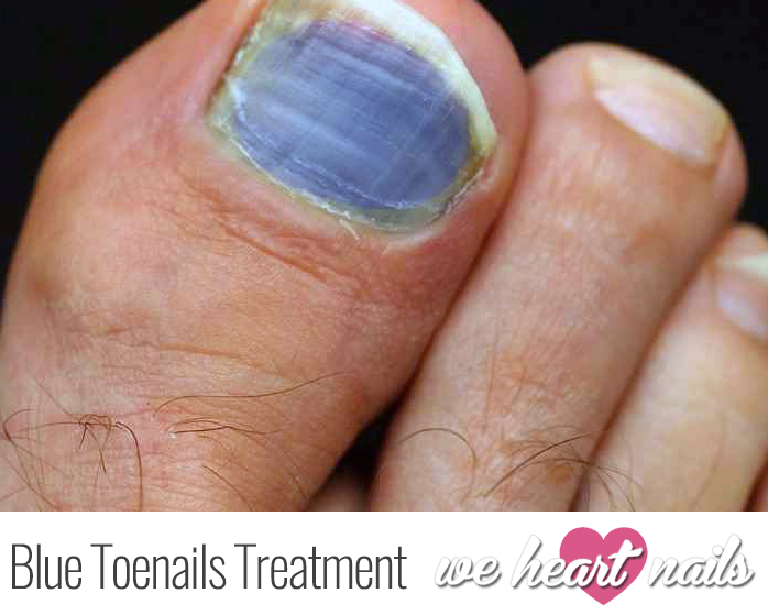 Bruised Blue Toenails Causes Prevention Treatments