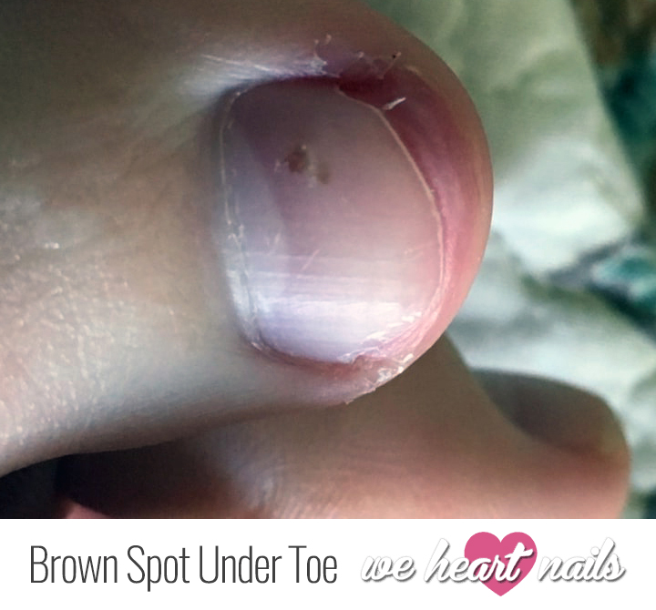 Small black dot on toenail