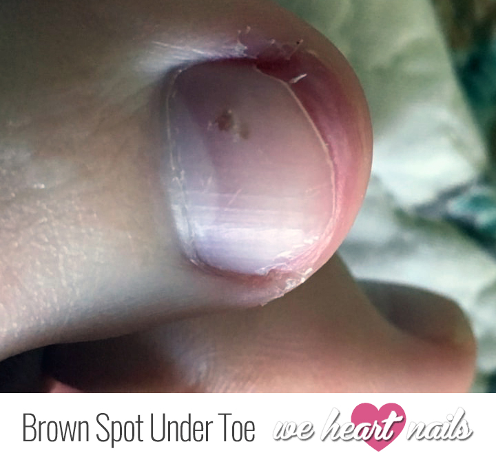 A woman said she thought the small dark spot underneath her toenail was a  mole. It turned out to be skin cancer. - Yahoo Sports