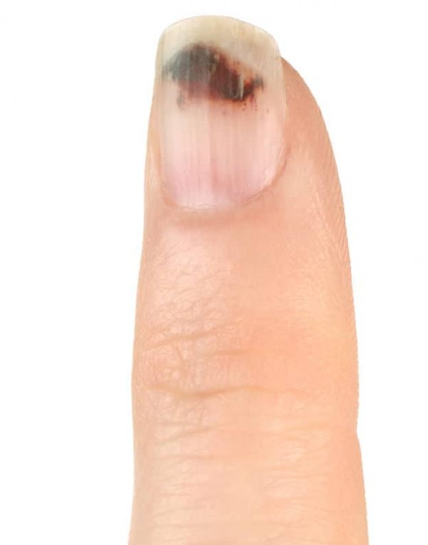 Dark Fingernails | Causes, Treatment &amp; Prevention | Top Tips