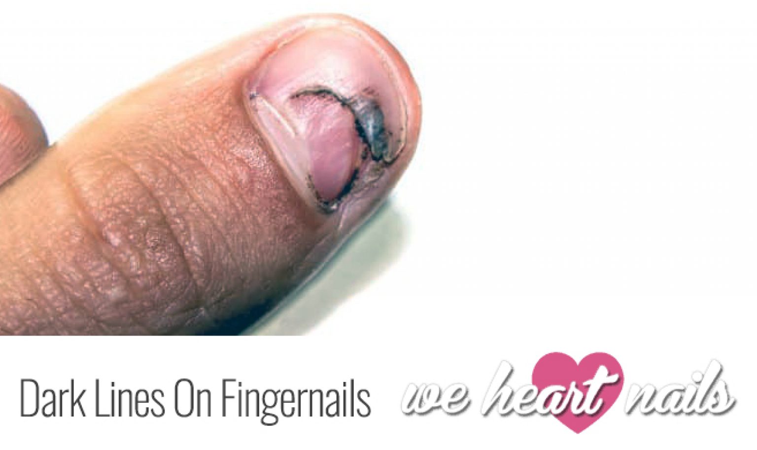 Dark Lines on Fingernails Causes, Prevention & Treatment