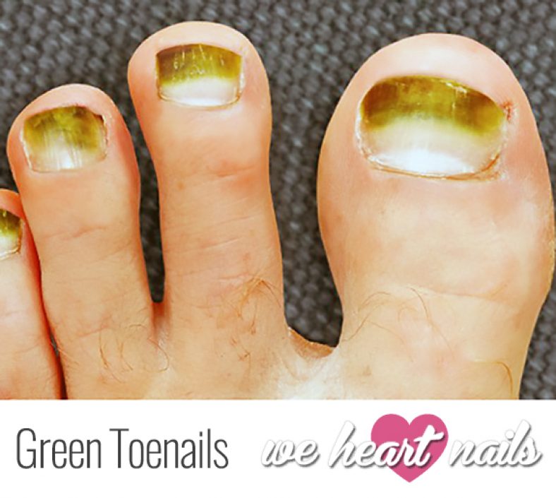 Ugly Green Toenails Causes Prevention Treatment