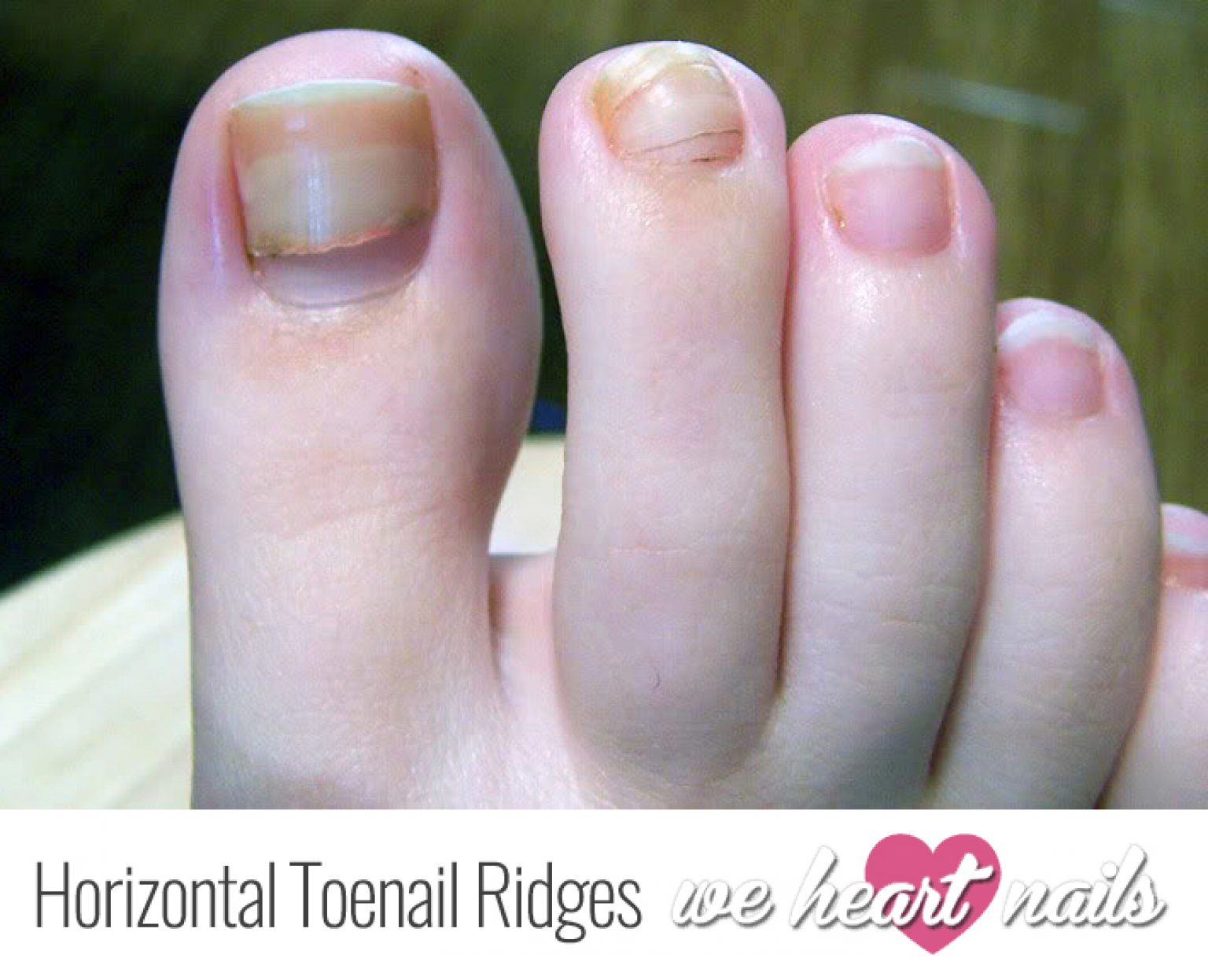 Horizontal Red Line On Toenail