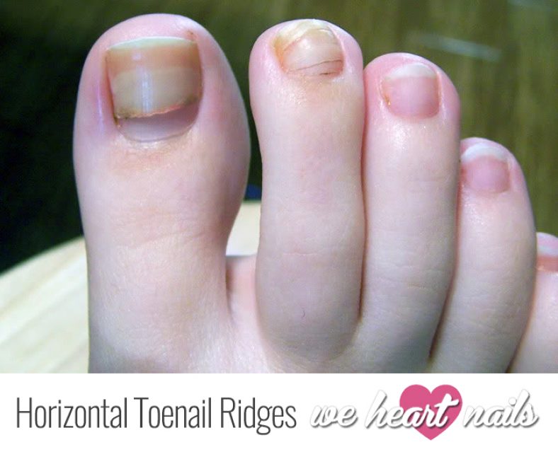 what-are-those-brown-horizontal-lines-on-my-toenail-it-feels-like-a