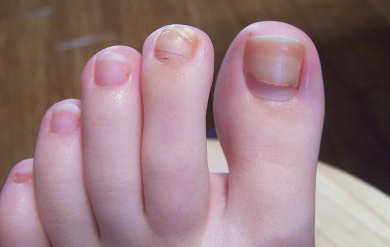 ridges-in-fingernails-toenails-vertical-horizontal-vitamin