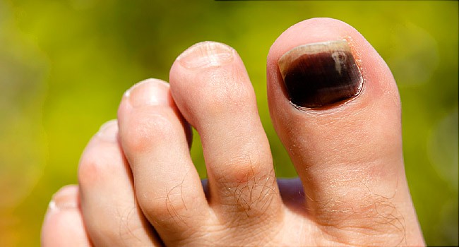 Purple Toenails Causes Prevention Treatment