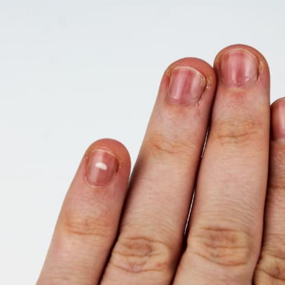 Red Lines On Fingernails - Causes, Prevention & Treatment