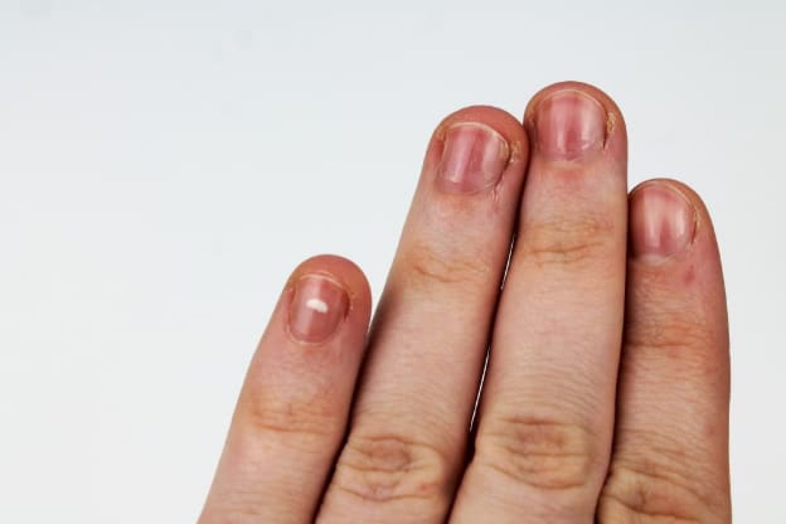 red-lines-on-fingernails-causes-prevention-treatment