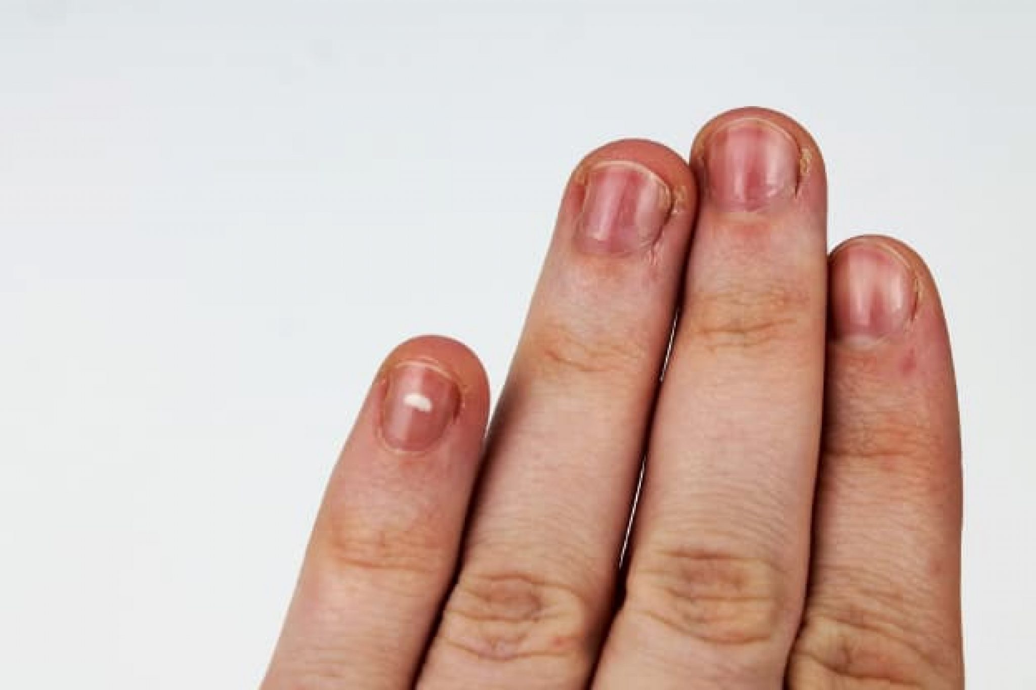 Redness of the nail bed caused by infection - wide 1