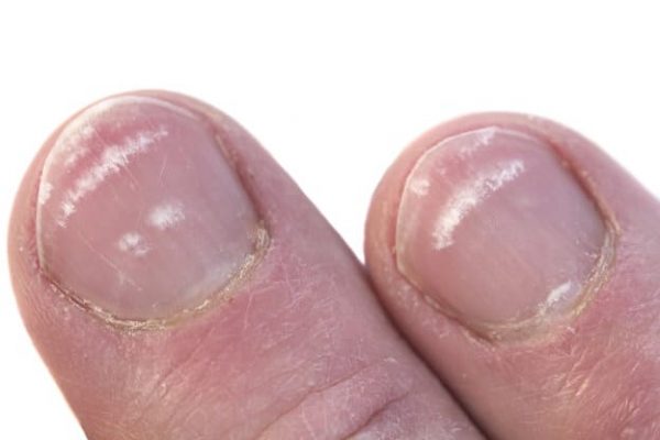 White Lines on Nails - Causes, Prevention & Treatment