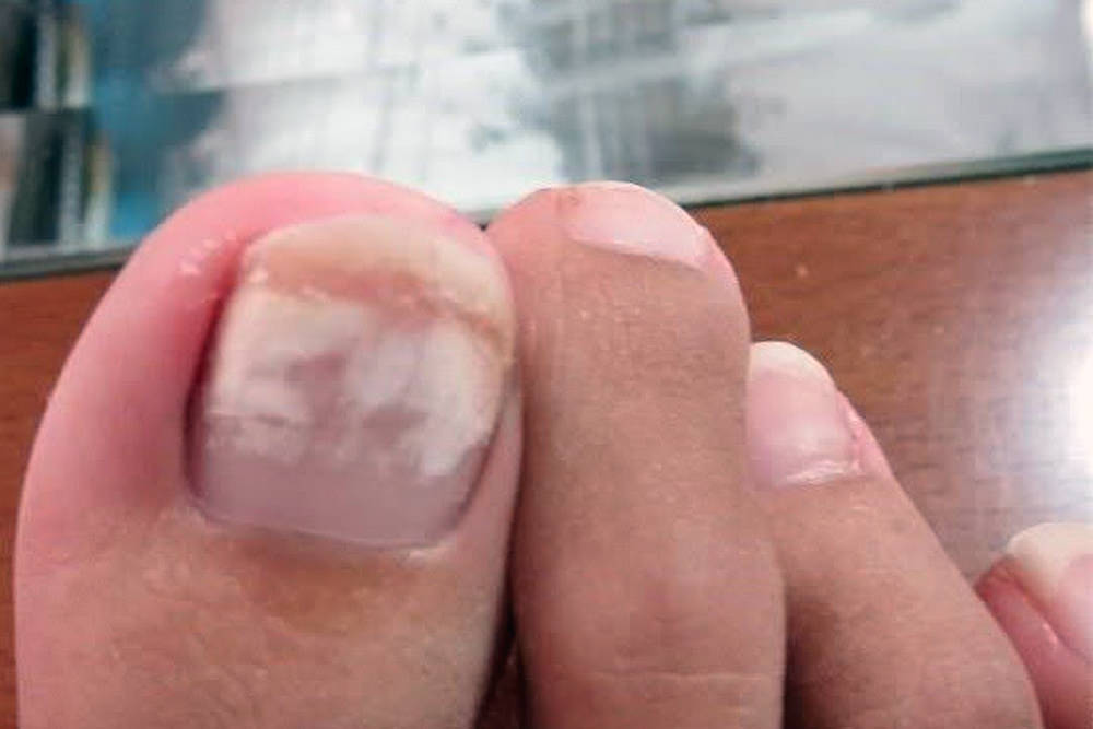 What Makes White Spots On Toenails